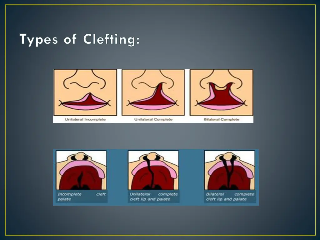 types of clefting