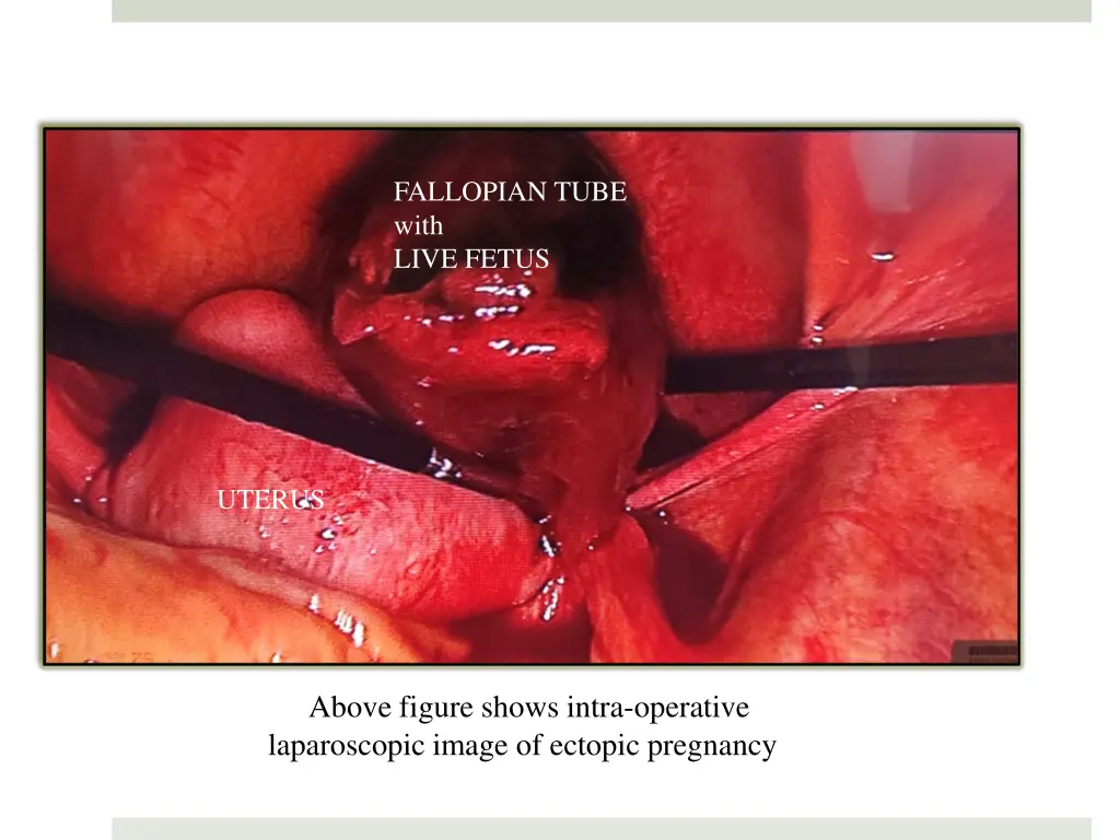 fallopian tube with live fetus