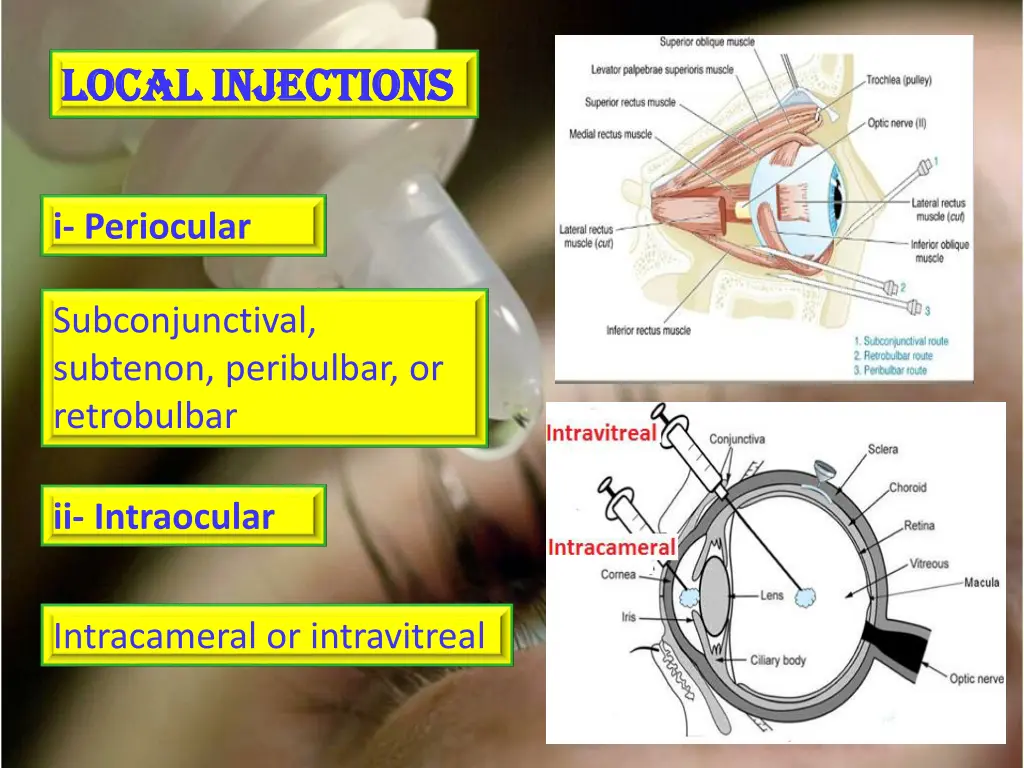 local injections local injections