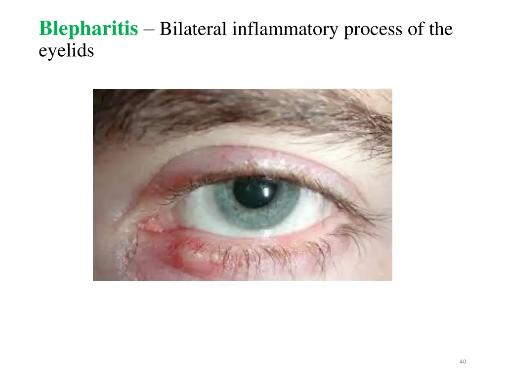 blepharitis bilateral inflammatory process