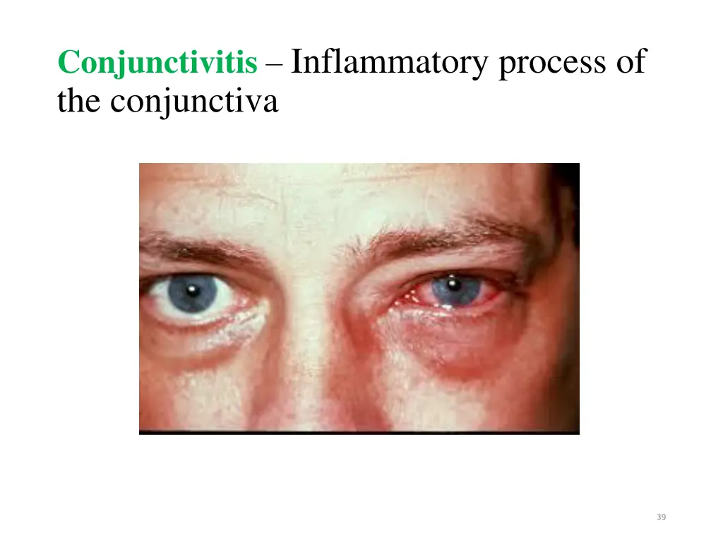 conjunctivitis inflammatory process