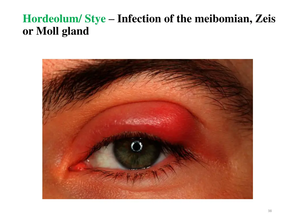 hordeolum stye infection of the meibomian zeis