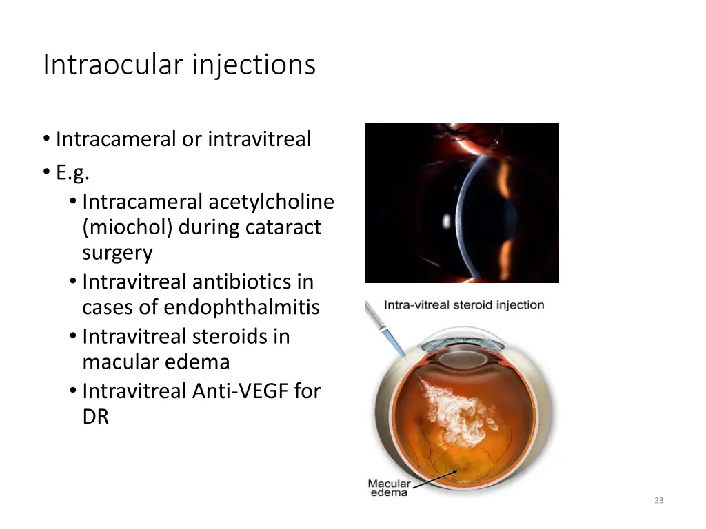 intraocular injections