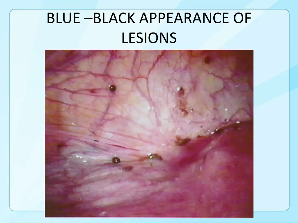 blue black appearance of lesions