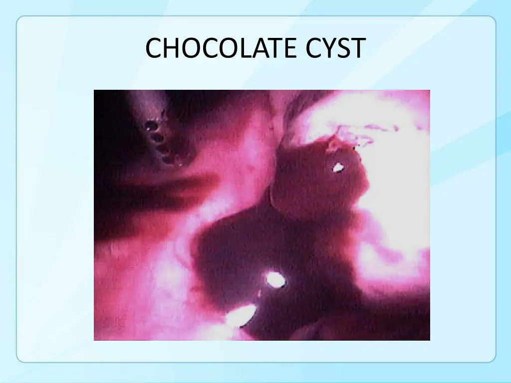 chocolate cyst