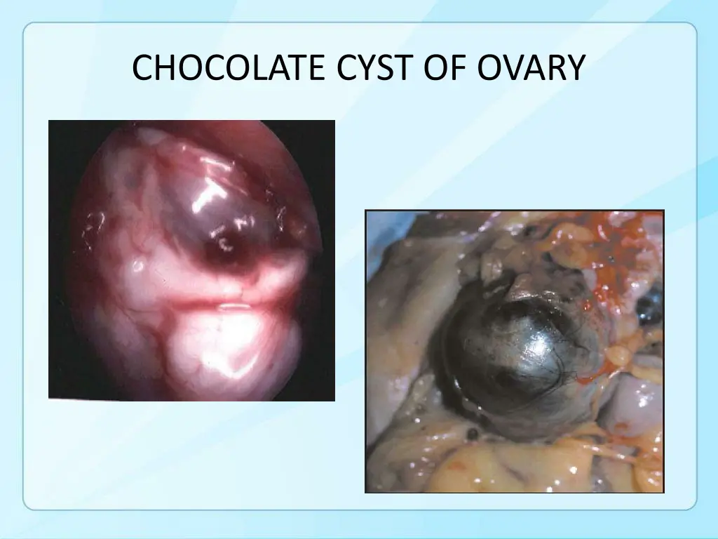 chocolate cyst of ovary 1