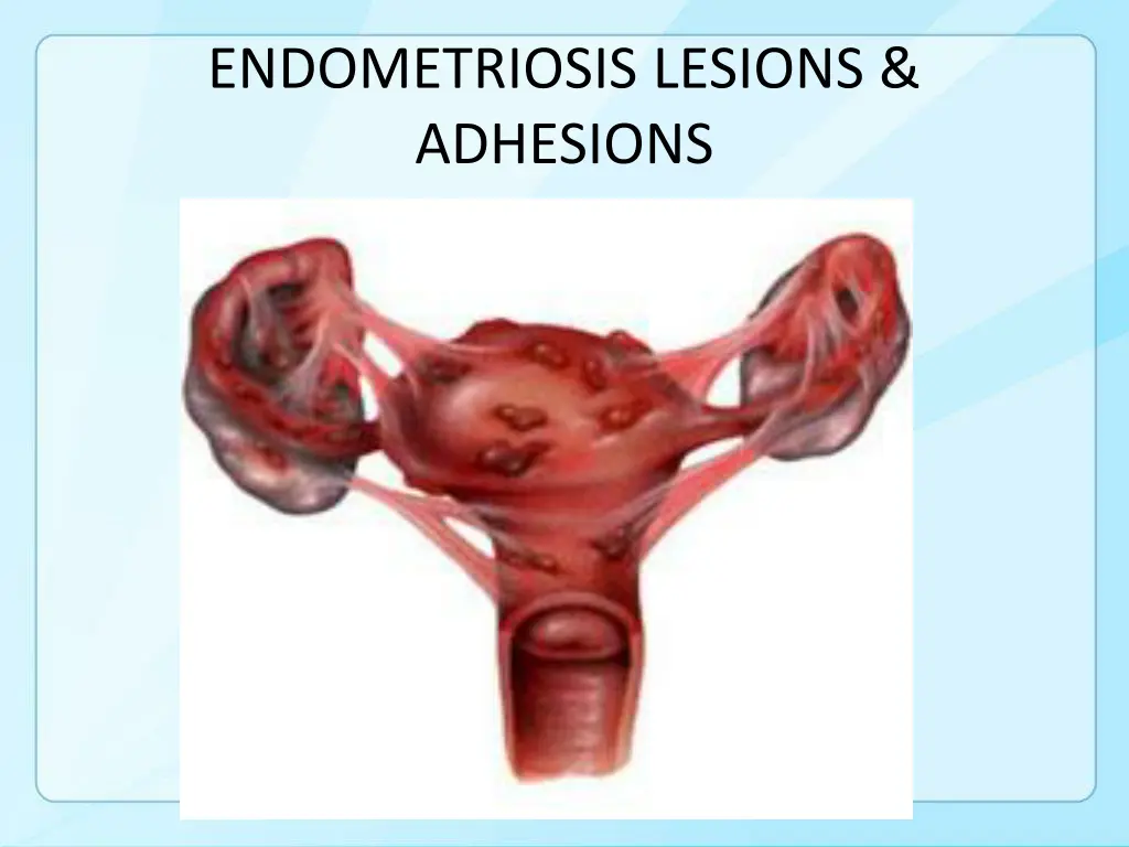 endometriosis lesions adhesions