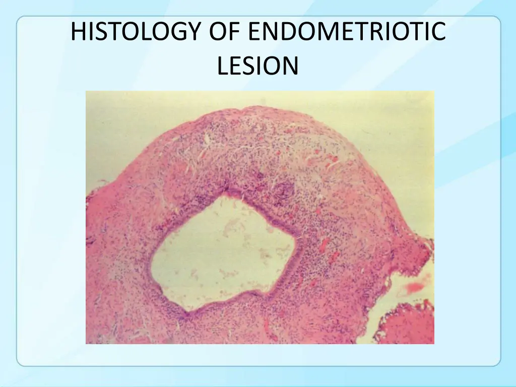 histology of endometriotic lesion