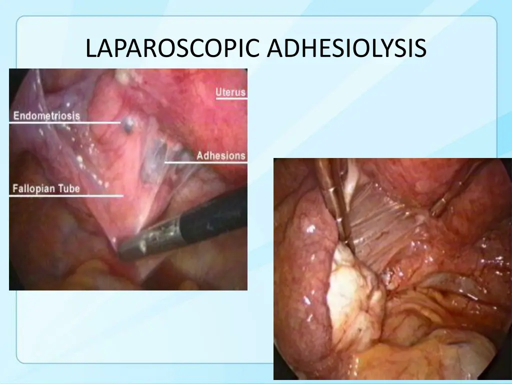 laparoscopic adhesiolysis