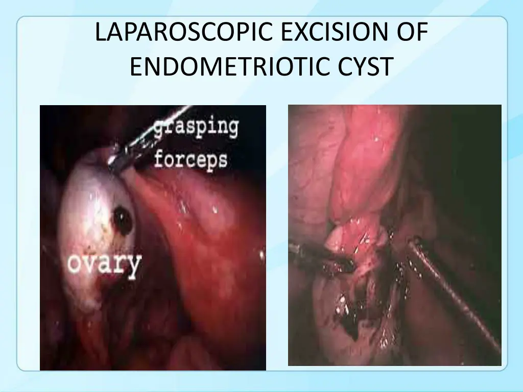 laparoscopic excision of endometriotic cyst