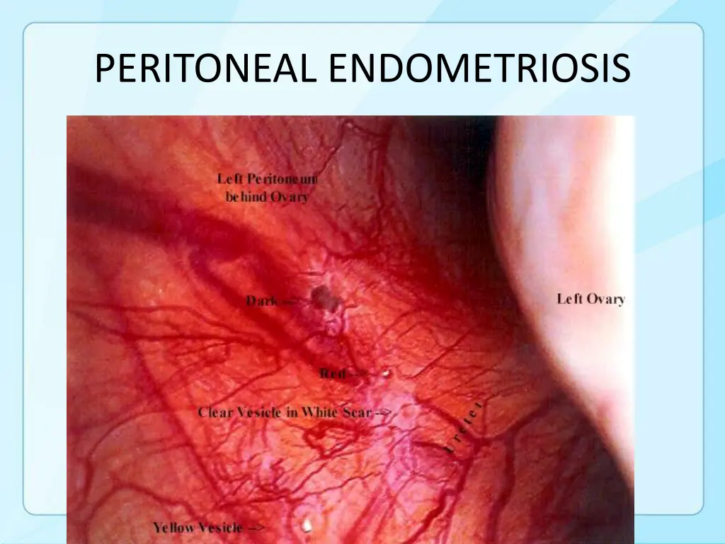 peritoneal endometriosis