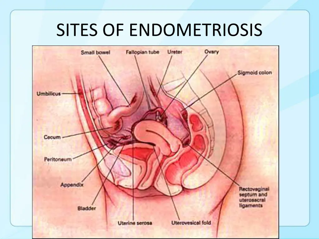 sites of endometriosis 1