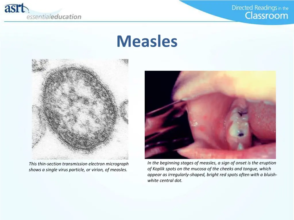 measles 2