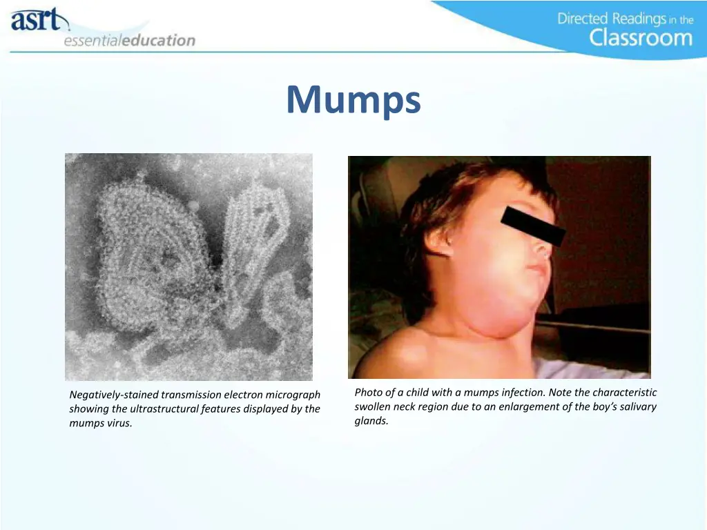 mumps 2