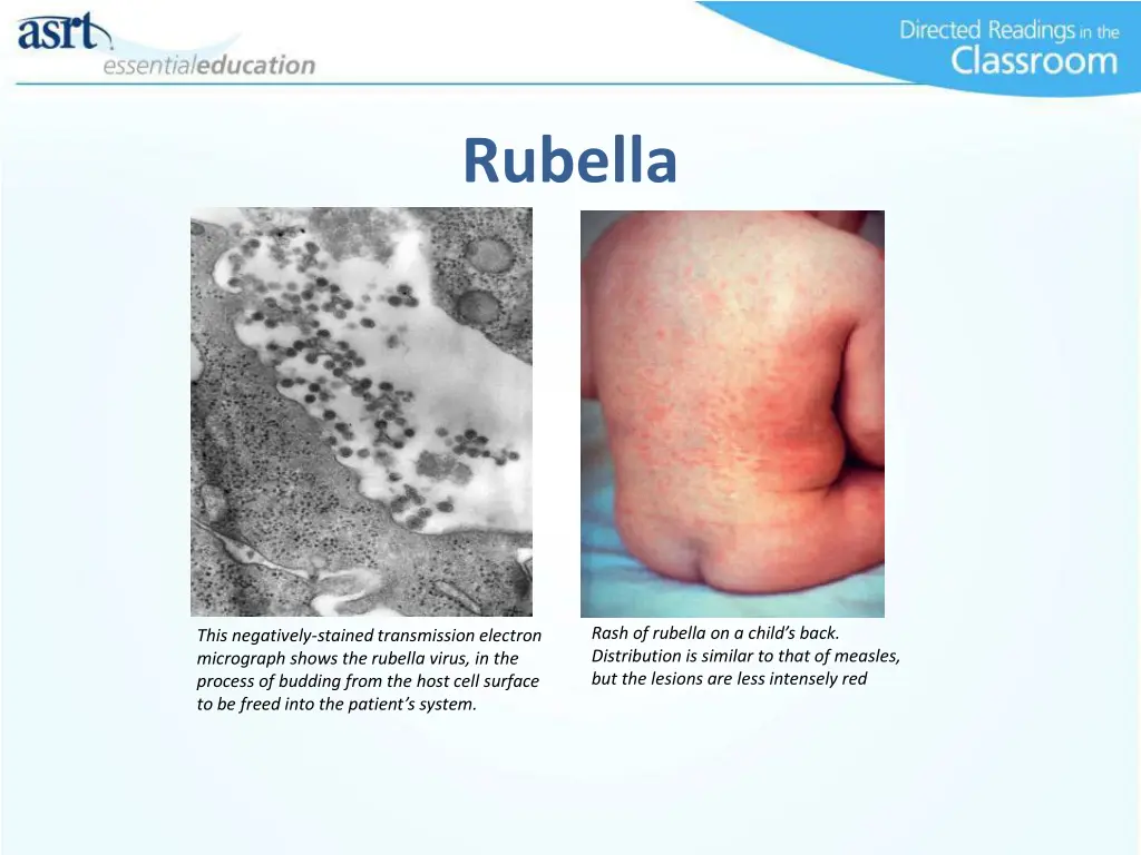 rubella 1