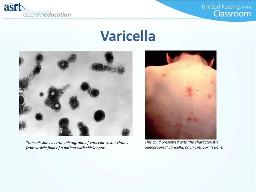 varicella 2