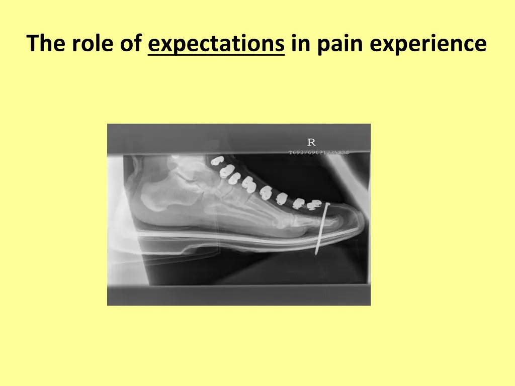 the role of expectations in pain experience