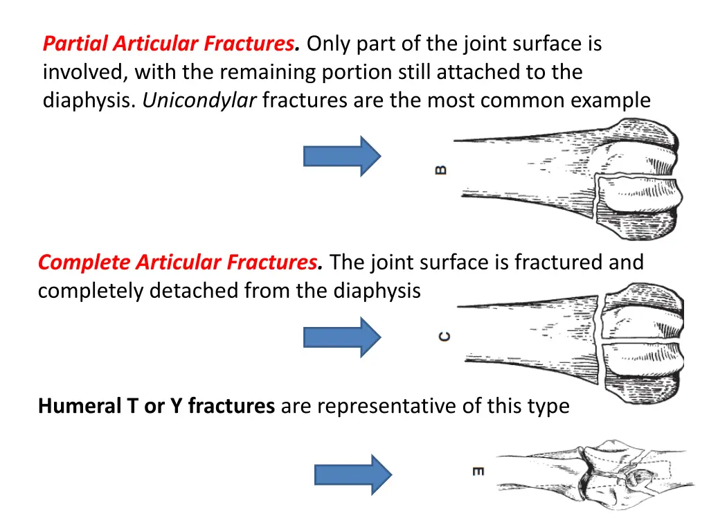 partial articular fractures only part