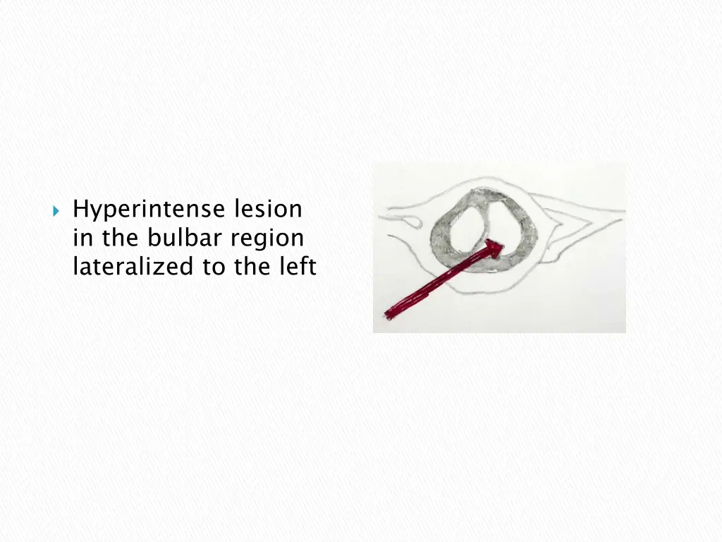 hyperintense lesion in the bulbar region