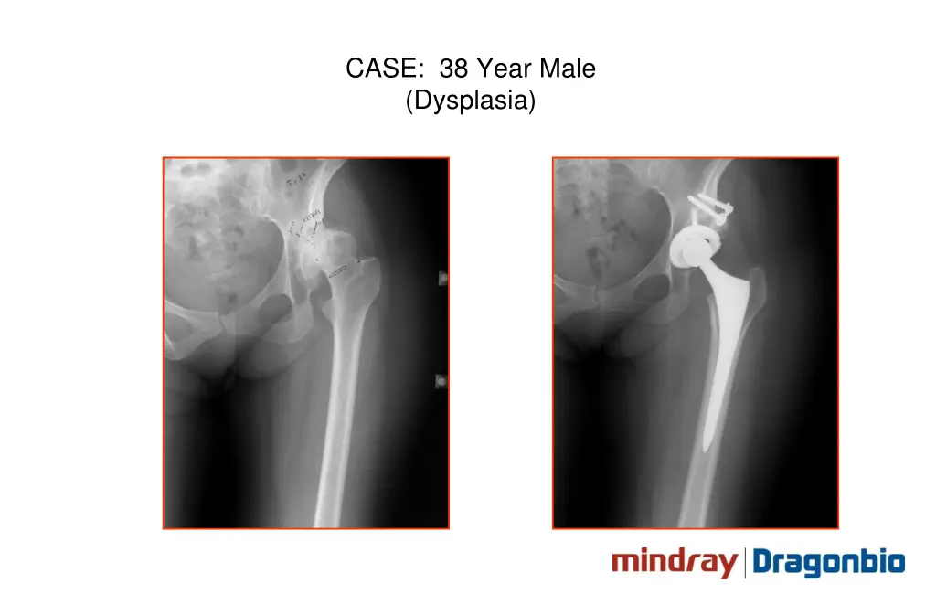 case 38 year male dysplasia