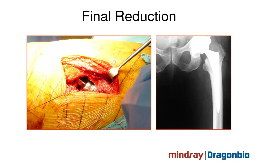 final reduction