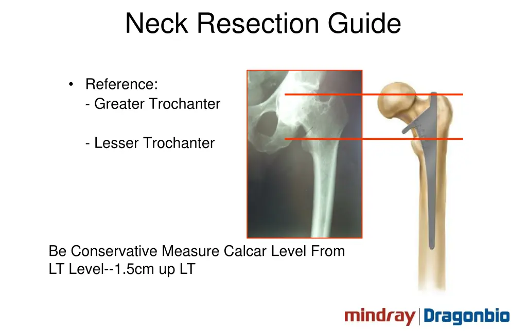 neck resection guide