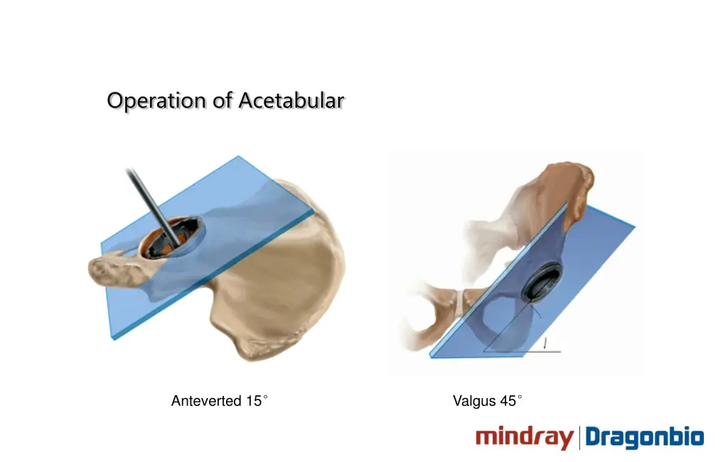 operation of acetabular 1