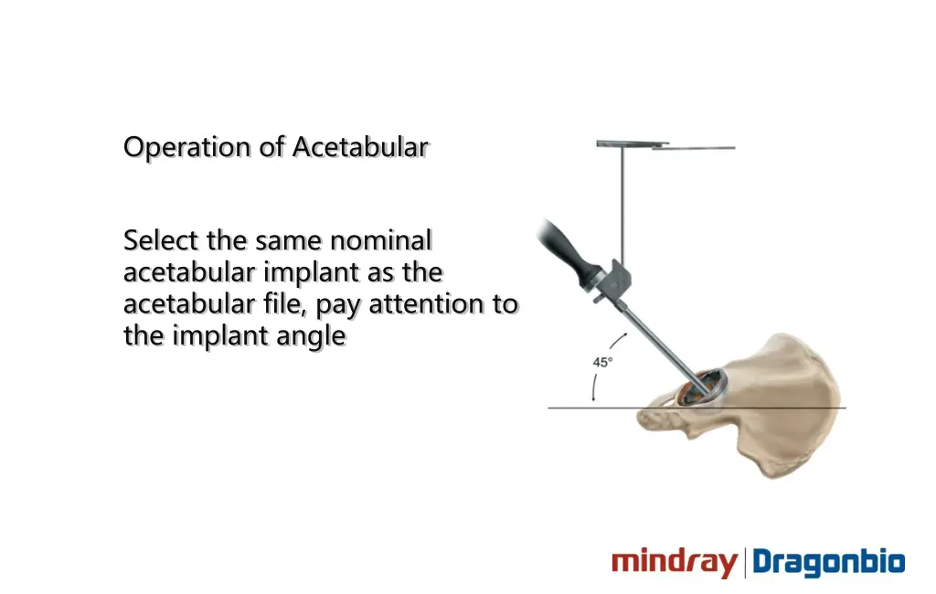 operation of acetabular 2