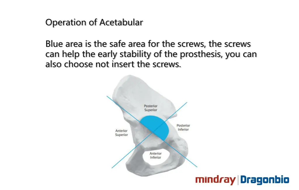 operation of acetabular 3