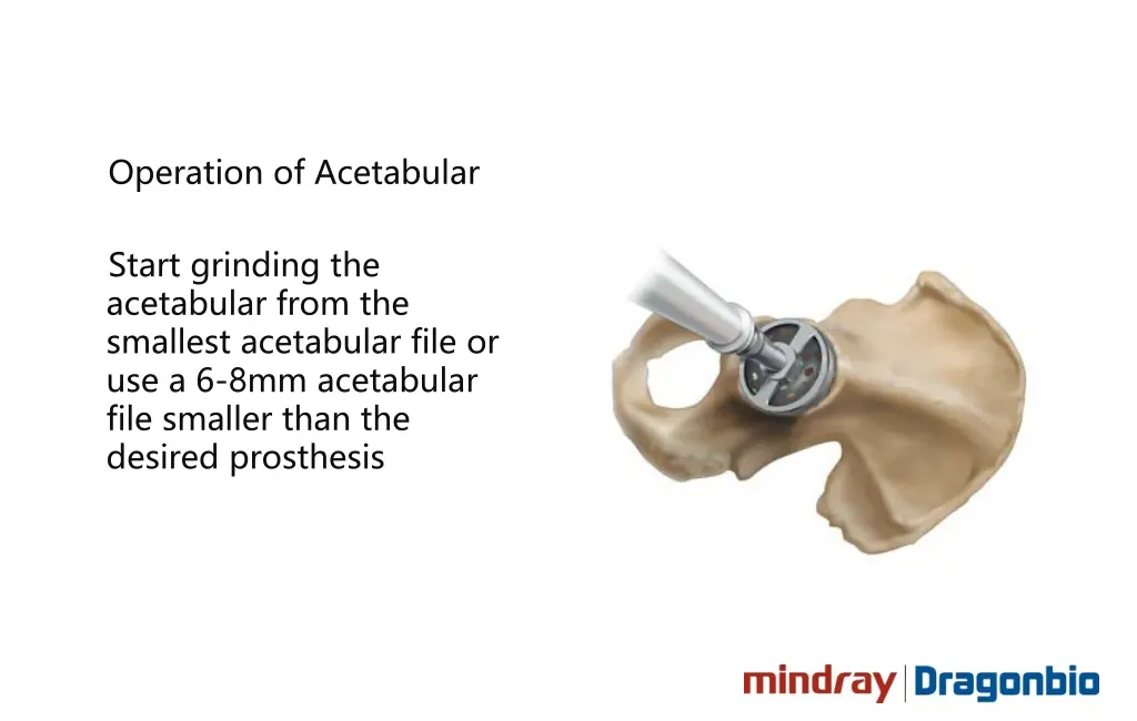 operation of acetabular