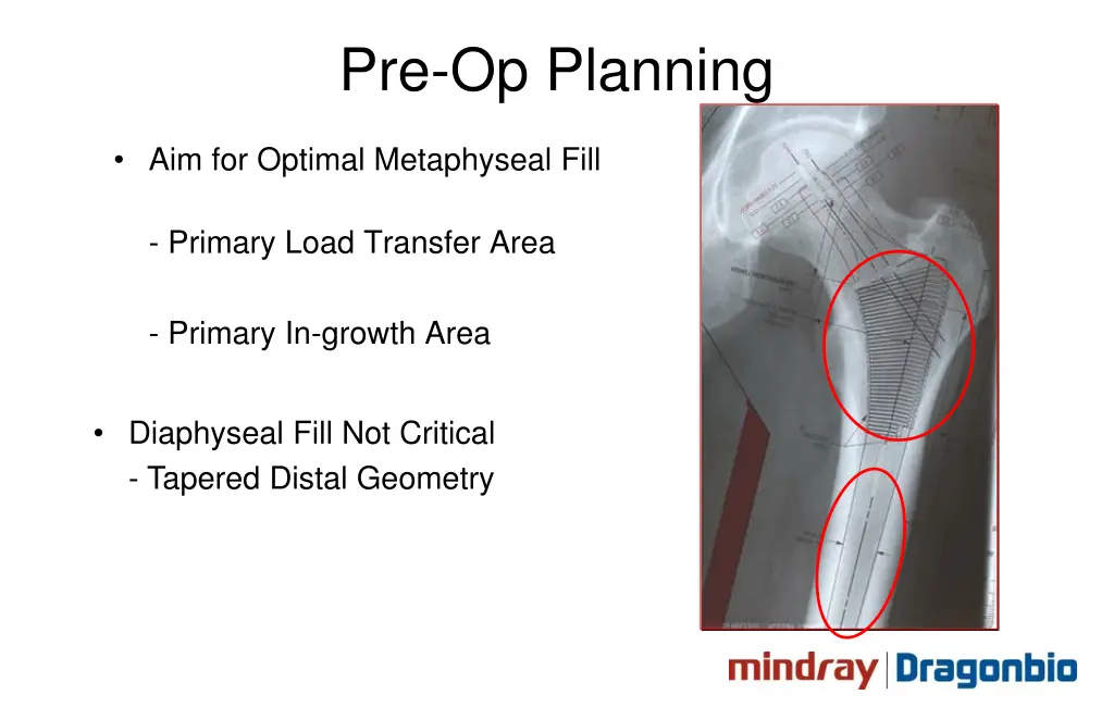 pre op planning 1