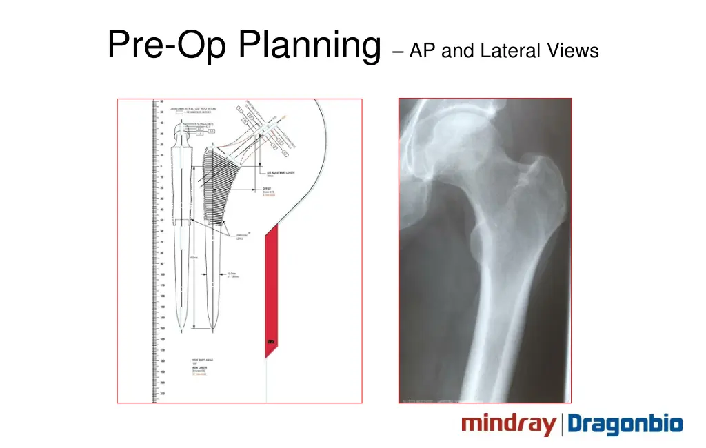 pre op planning ap and lateral views