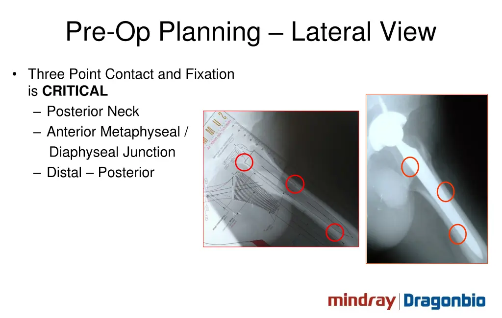 pre op planning lateral view