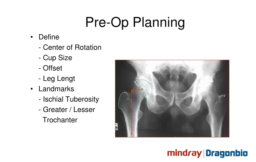 pre op planning