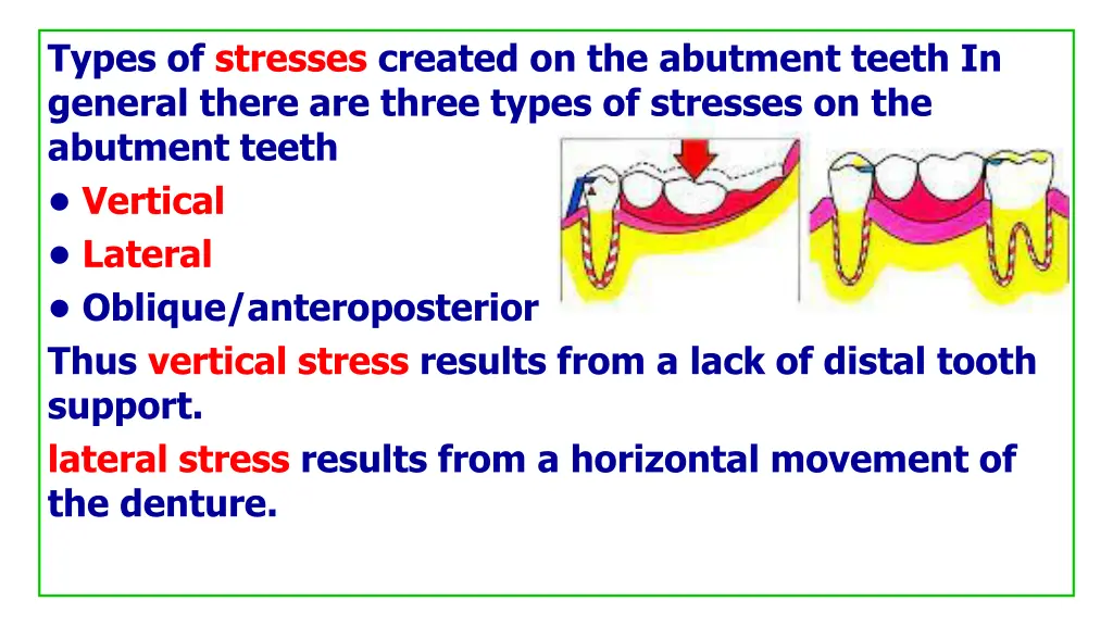 types of stresses created on the abutment teeth