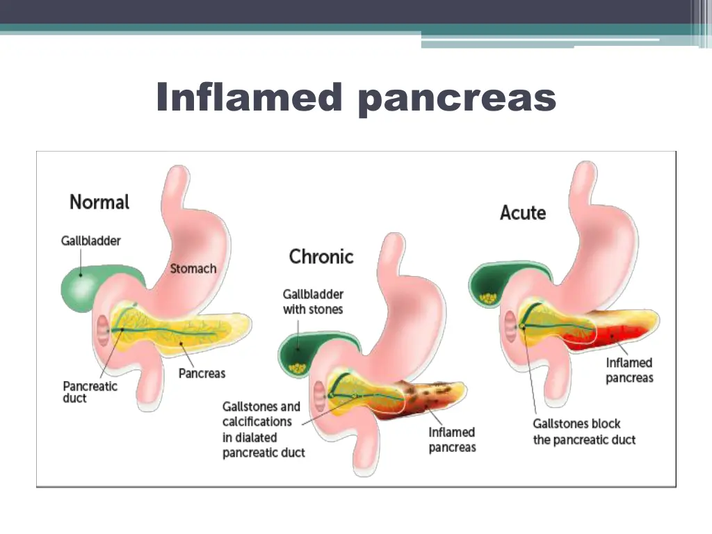 inflamed pancreas