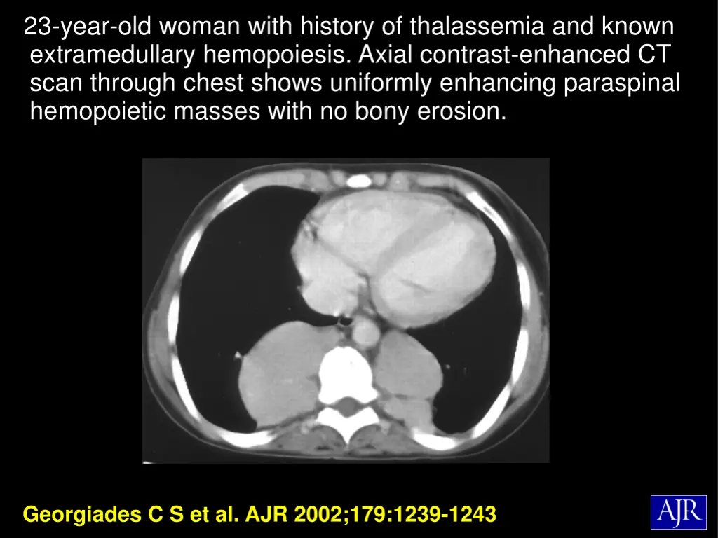 23 year old woman with history of thalassemia 1