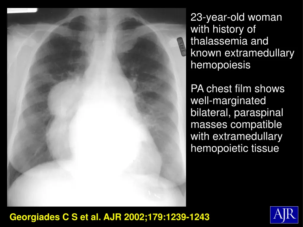 23 year old woman with history of thalassemia