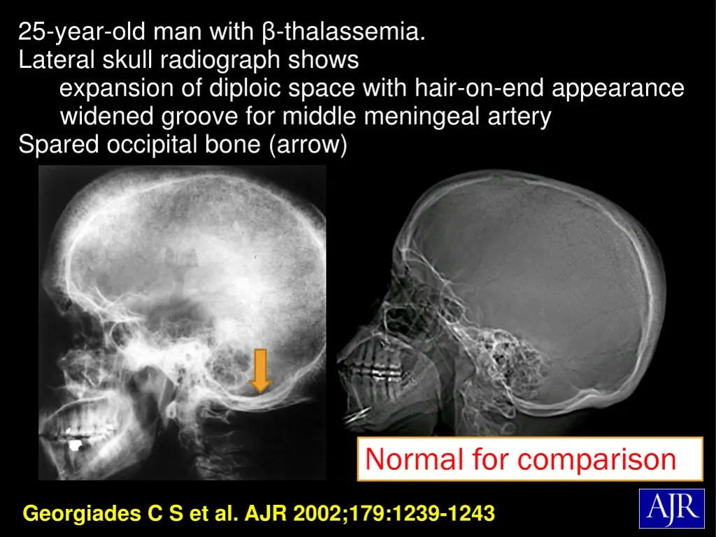 25 year old man with thalassemia lateral skull