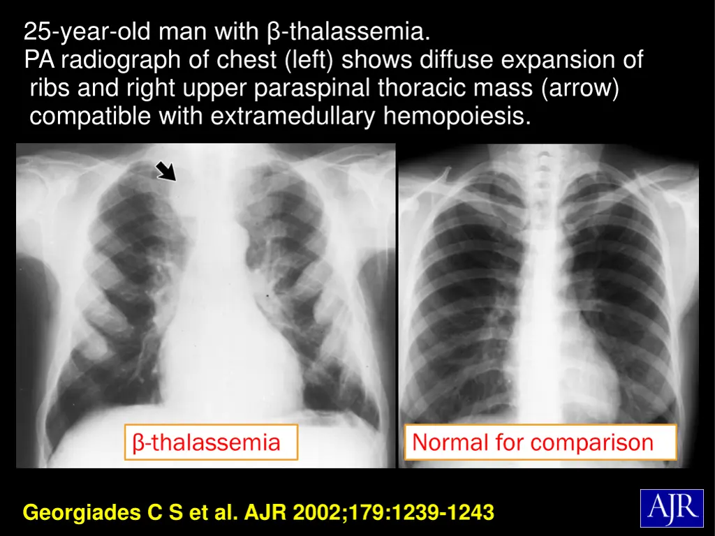 25 year old man with thalassemia pa radiograph