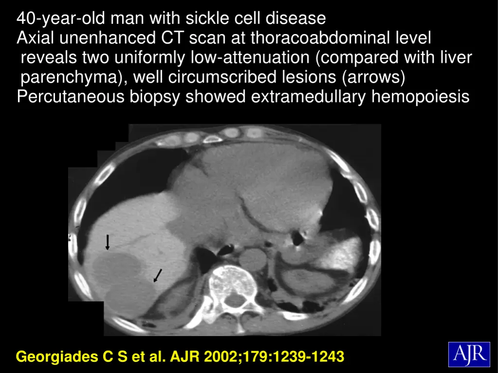 40 year old man with sickle cell disease axial