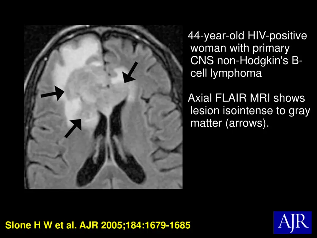 44 year old hiv positive woman with primary