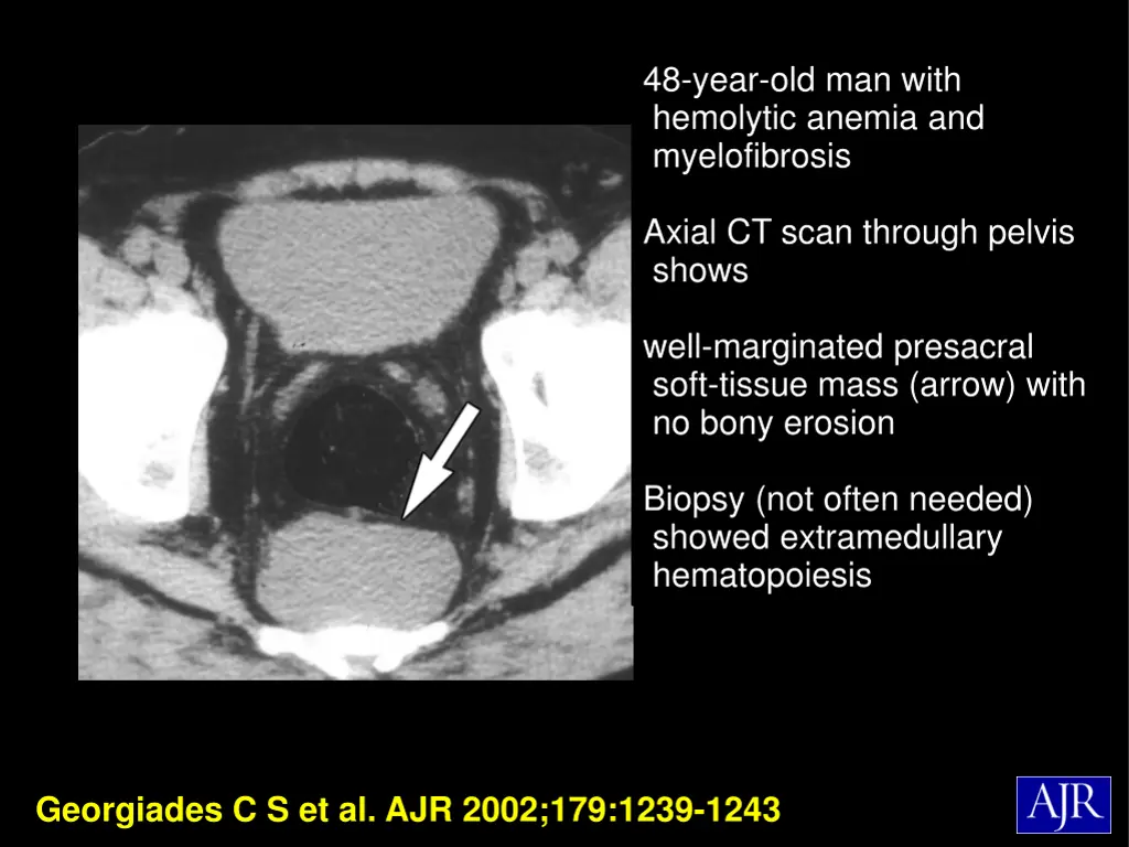 48 year old man with hemolytic anemia