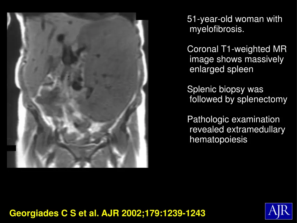 51 year old woman with myelofibrosis