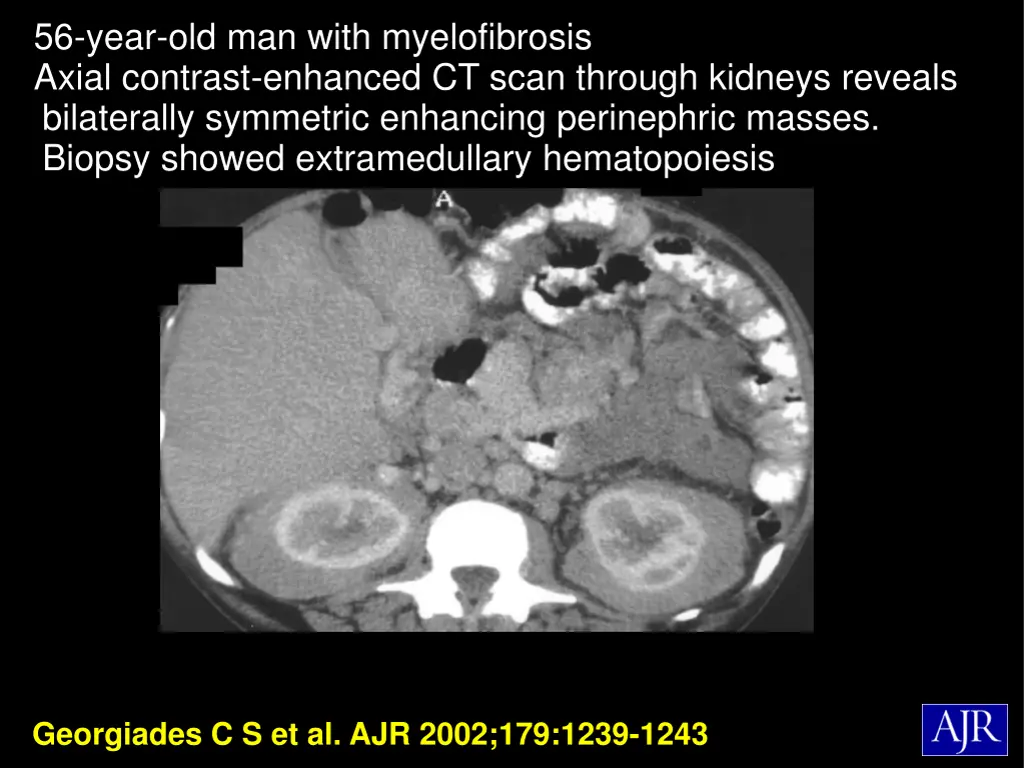 56 year old man with myelofibrosis axial contrast