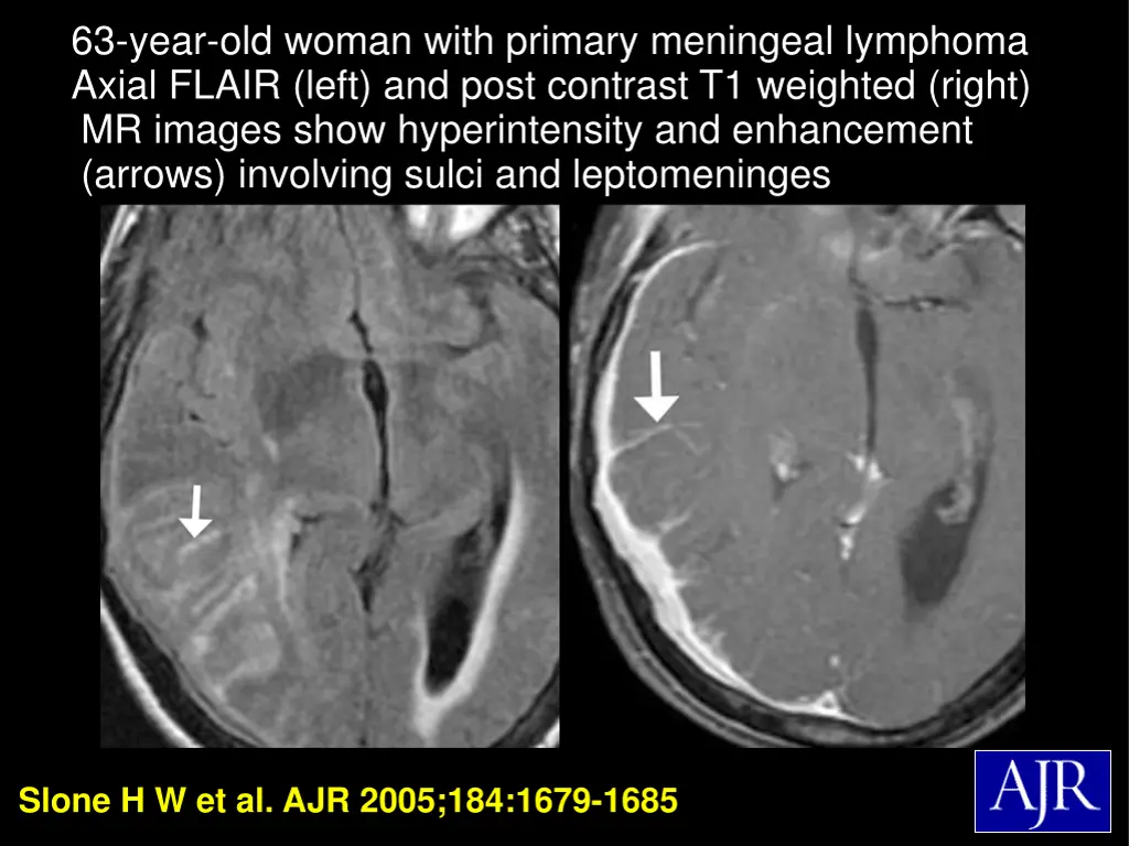 63 year old woman with primary meningeal lymphoma