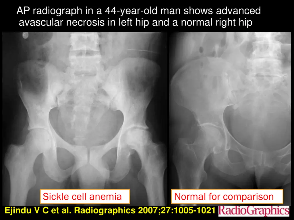 ap radiograph in a 44 year old man shows advanced