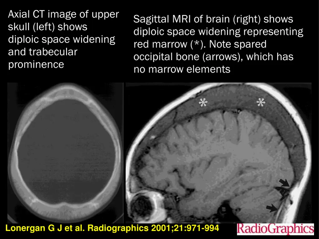 axial ct image of upper skull left shows diploic