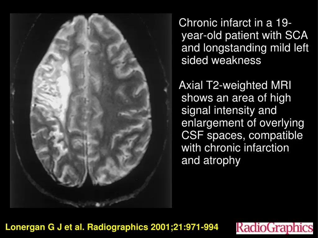 chronic infarct in a 19 year old patient with