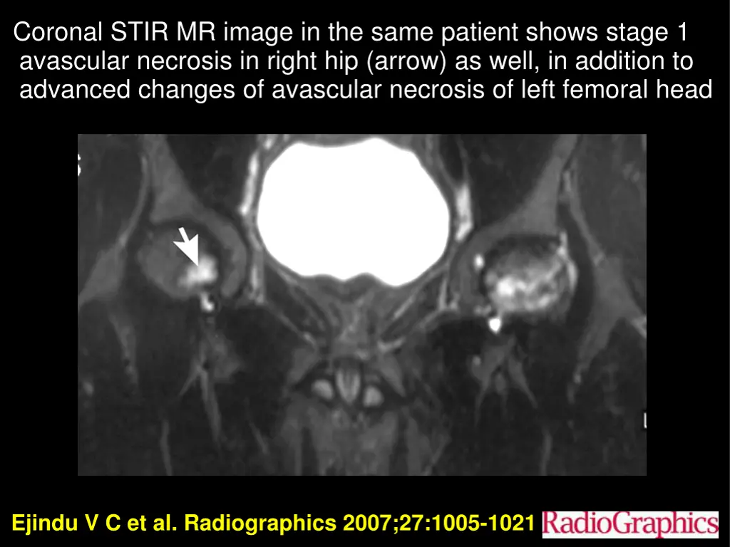 coronal stir mr image in the same patient shows